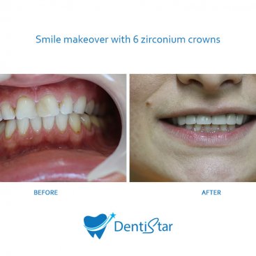 Smile makeover with 6 zirconium crowns